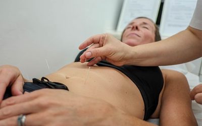 Can Acupuncture Help Menopause Symptoms?